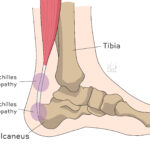 [doctormodu]1 아킬레스건염 종류 Achilles tendinopathy classification