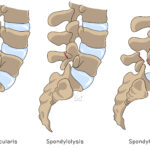 [doctormodu]1 척추분리증 spondylolysis
