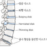 [doctormodu]1 허리 퇴행성 변화 종류 disc