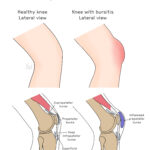 [doctormodu]1 prepatellar bursitis patho
