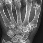 [doctormodu]2 CMC arthritis X ray