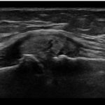 [doctormodu]2 Meniscus MCL tear US