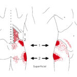 [doctormodu]2 TLJ syndrome dermatome