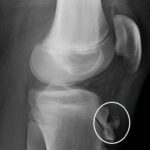 [doctormodu]2 osgood schlatter X-ray