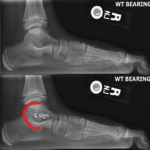 [doctormodu]2 talocalcaneal coalition C-sign X-ray