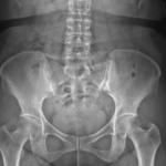 [doctormodu]3 SI joint arthritis