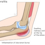 [doctormodu]1 olecranon bursitis