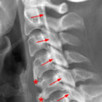 [doctormodu]1 OPLL x ray