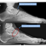 저작권[doctormodu]1 talonavicular arthritis x-ray
